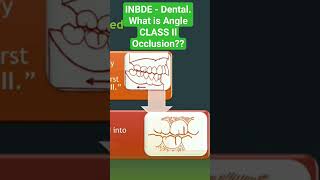 INBDE - Dental Occlusion. What is Angle CLASS II occlusion??