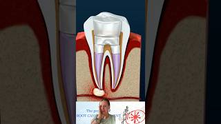 Root Canal Treatment & Tooth Abscess