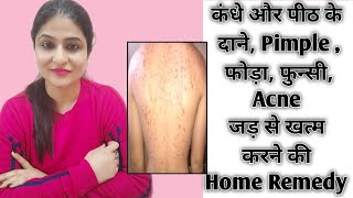 How To Get Rid Of Back N Shoulder Acne Fast At Home | Back Acne Removal Home Remedy | 👍👍