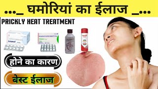 घमोरियां का ईलाज | घमोरियां क्यों होती है और कैसे ठीक करे ? Heat Rash Treatment In Hindi | Prickly