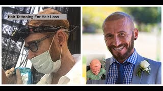 Why Choose A Scalp Tattoo To Treat Men's Hair Loss?