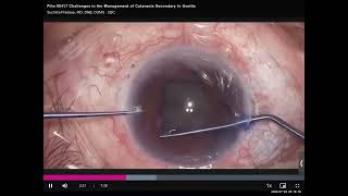 Cataracts Secondary to Uveitis