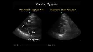 Ultrasound Diagnosis of a Left Atrial Myxoma in the Emergency Department