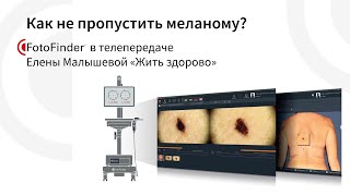 Как не пропустить меланому? Отрывок передачи на Первом канале