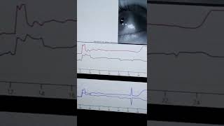 187.electronystagmography #tests for vertigo #ENG #audiology