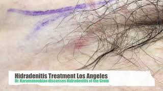 Hidradenitis Treatment Center Los Angeles