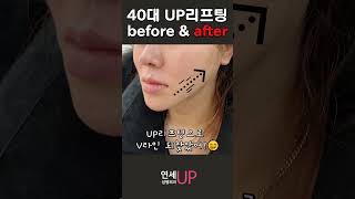 40대도 매끄러운 얼굴라인! #uplifting #미니거상 #안면거상