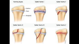 SALTER - HARRIS CLASSIFICATION OF FRACTURES