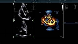 〖Echocardiography〗 The Tricuspid Valve in 3D - TTE 🫀