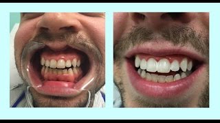 How To Whiten Teeth At Home | Whiten Teeth With This Homemade Toothpaste! || 100% WORKS