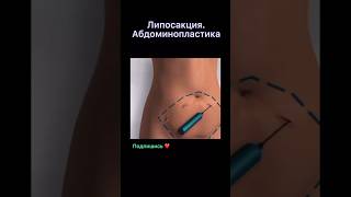 Вот как удаляют жир из живота - пластические хирурги🧑‍⚕️ #медицина #хирург