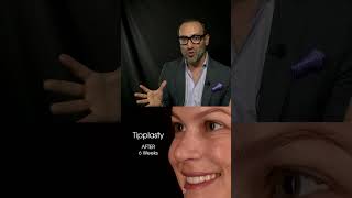 Tipplasty (Nasal Tip Rhinoplasty) Explained by Dr. Kian.