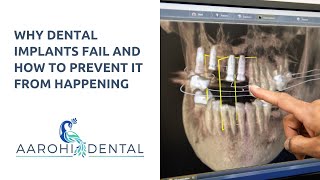 Why Dental Implants Fail and How To Prevent it From Happening