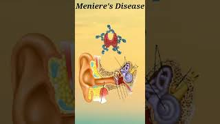 meniere's Disease short knowledge