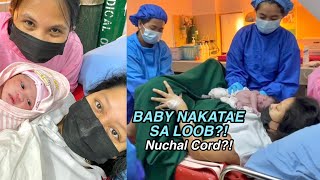 MECONIUM BABY WITH NUCHAL CORD