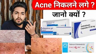 Why Creams Make Your Acne Worse ? | Blackheads Convert in Acne