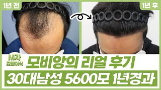 [Mobien TV] 30대 남성 M자 모발이식 절개 5600모 1년경과 #광주탈모치료 #전남모발이식