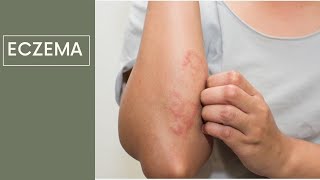 Dermatite / Eczéma -التهاب الجلد التحسسي