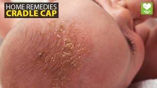 Cradle Cap - Home Remedies | Health Tips - Education