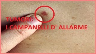 Tumori: i principali campanelli d’allarme da non sottovalutare- Italy365