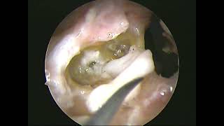 Temporal bone dissection endoscopic two handed part 5(unedited)-dr.shreekantha acharya