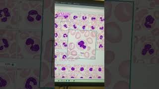 Caso Clinico de Hematologia #1