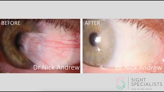 Pterygium surgery explained