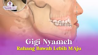 ANIMASI MERAPIKAN GIGI NYAMEH ATAU RAHANG BAWAH LEBIH MAJU