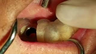 Guided Implant Surgery - Mandibular First Molar