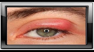 آنکھ کی سوزش | Aankhon Ki Sozish | Inflammation Of The Eye In Hindi