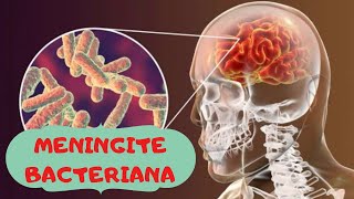 AULA 57: MENINGITE BACTERIANA