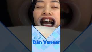 Dán Veneer tại Nha Khoa Sài Gòn Bình Dương