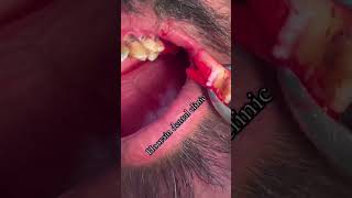 How to use luxator and forceps to remove upper decayed first molar