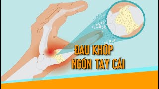 Đau khớp ngón tay cái #đau đốt ngón tay cái#đau khớp giữa ngón tay cái#viêm khớp ngón tay cái