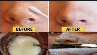 easy way to remove blackheads from Nose & Chin at home remedies| Beauty with pooja|