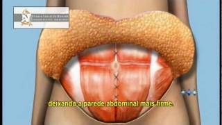 Abdominoplastia (Cirurgia Plástica do Abdomen)