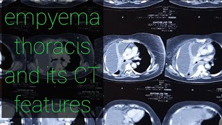 Empyema thoracis (a real case scenario )