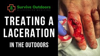 Outdoor Survival: Mastering Treatment Of Severe Lacerations