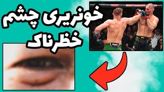 آسیب چشم شان استریکلند میتونه شرایط رو عوض کنه؟🤔