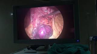 laparoscopic excision o f GIST in the Lesser curvature of stomach