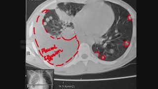 Pulmonary / Lung Metastasis • Radiology and Mechanism