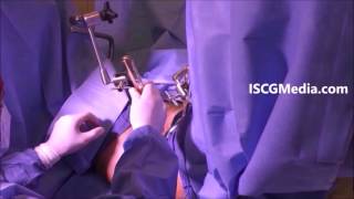 Zone Vaginoplasty Vaginal Rejuvenation & Rectocele Repair with Manual Robotic Arms