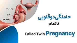 حاملگی دوقلویی ناتمام --- Infertility Treatment  and Twin Ectopic Pregnancy