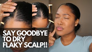 How to Get Rid of Dry Flaky Scalp: Ultimate Guide to Healthy Hair #dryscalp