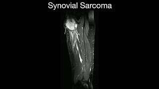 Synovial Sarcoma