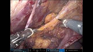 #178 Robotic Lateral Lymph Node Dissection Dr. Ankit Sharma, Dr. Avanish Saklani