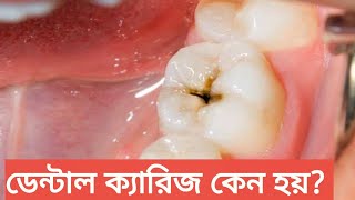 ডেন্টাল ক্যারিজ বা দাঁতের গর্ত কেন হয়? ডেন্টাল ক্যারিজের চিকিৎসা। Tech Dental Care