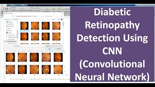 Diabetic Retinopathy Detection Using CNN Convolutional Neural Network | Diabetic Retinopathy Predict