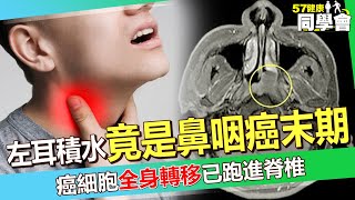 43歲壯年左耳積水「竟是鼻咽癌」？！癌細胞「全身轉移」已跑進脊椎嘆：剩頭髮指甲沒癌細胞...【 @57healthy  】#張金堅 醫師