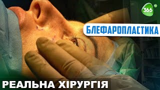 Блефаропластика. Як Зберегти Молодість Ваших Очей?